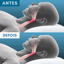 Protetor Bucal Anti-Ronco Znorex®