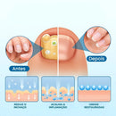 UngiGel - Adesivos para fungos