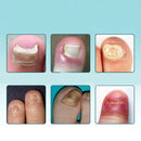 UngiGel - Adesivos para fungos